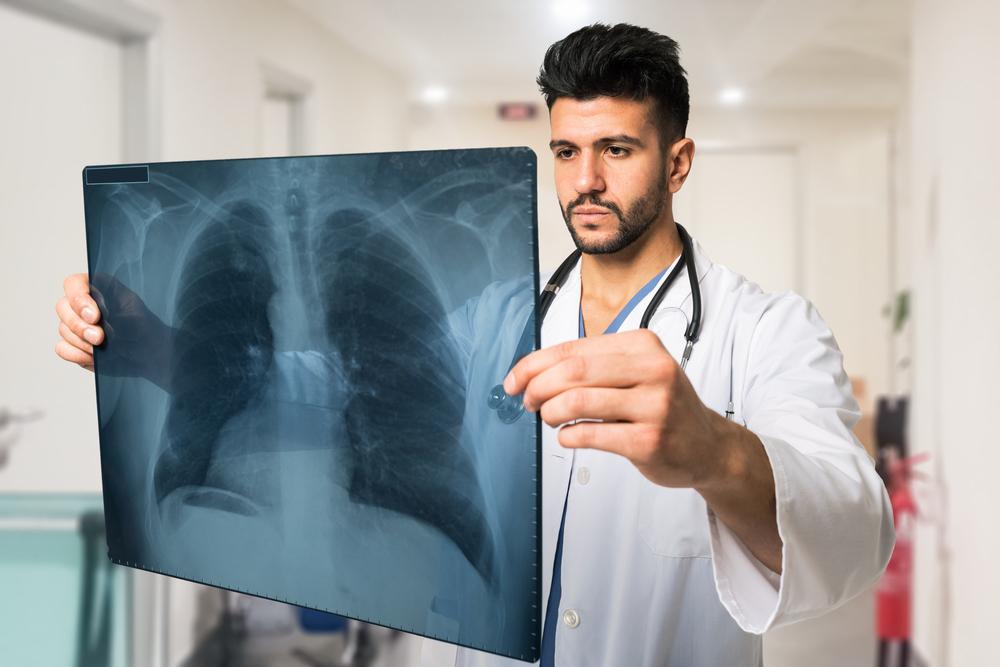 Lung Cancer – Causes, Symptoms, and Treatment