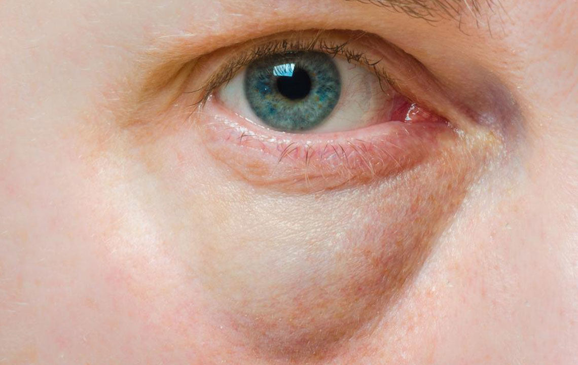 Bags Under the Eyes – Symptoms, Causes, and Treatment
